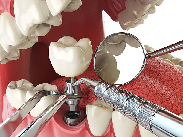 Best Emergency Broken Tooth Repair in Boulder, CO